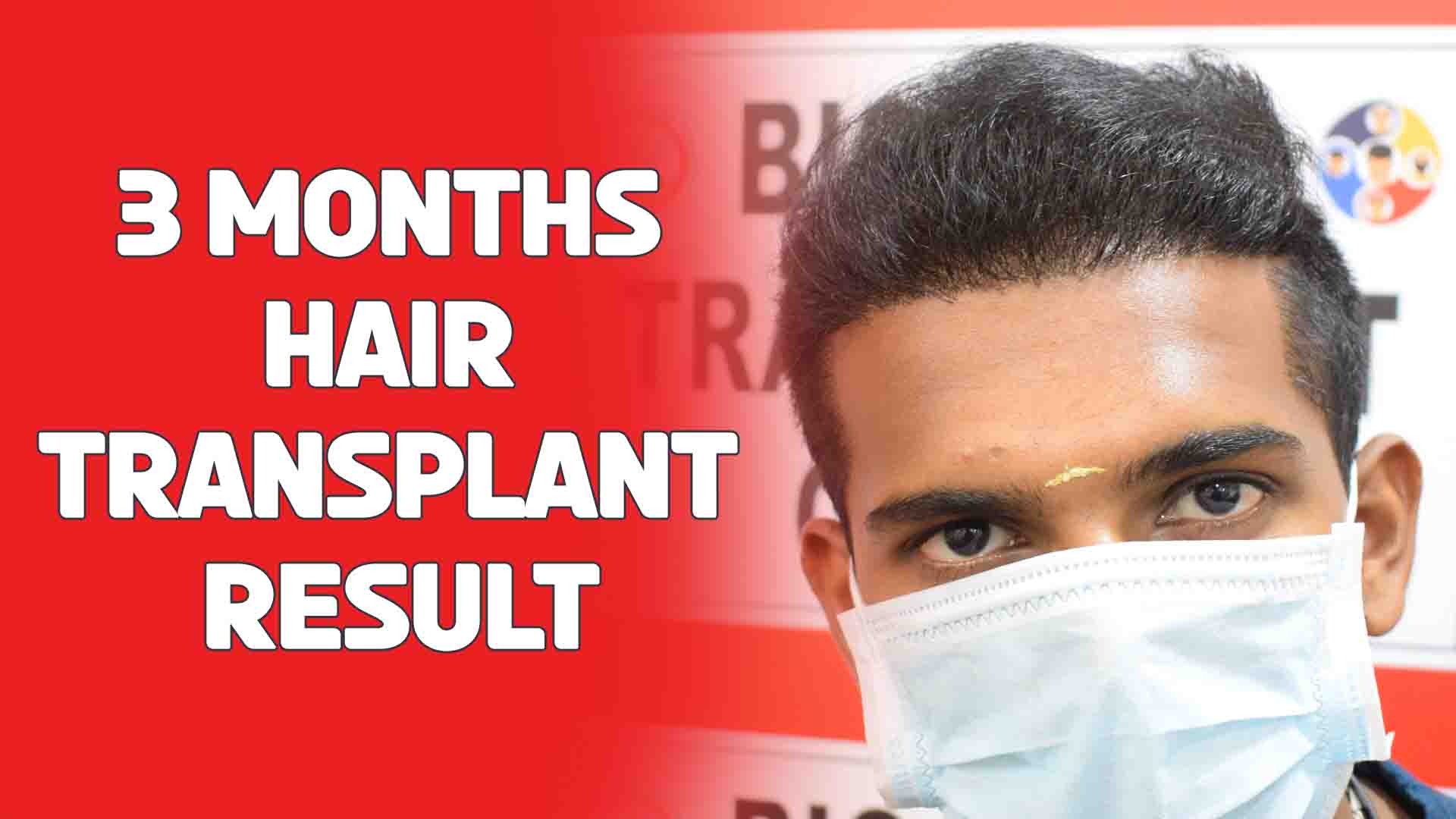 3 months hair transplant result