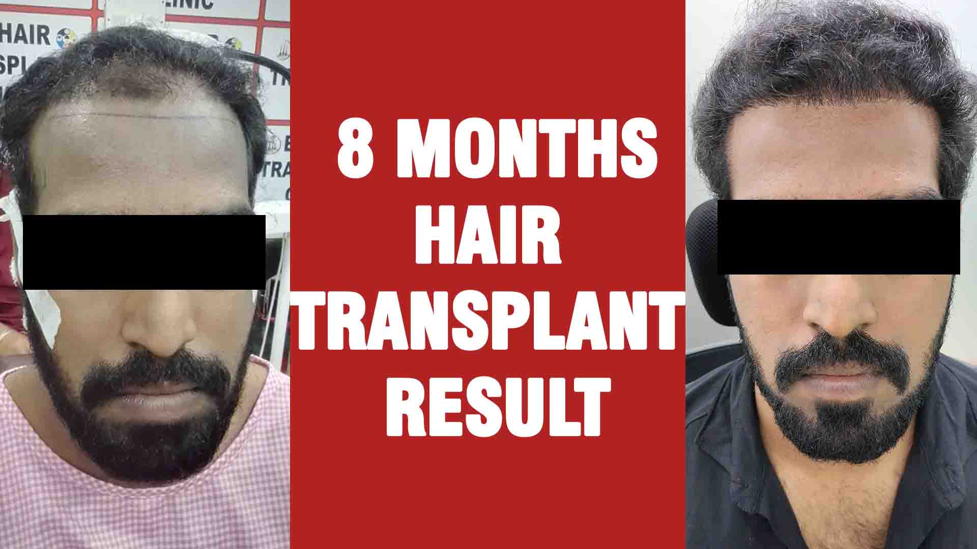 8 months hair transplant result