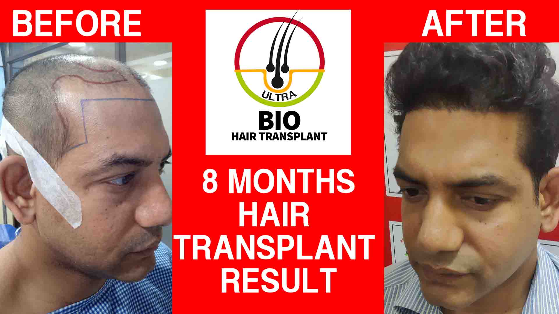 8 months hair transplant result