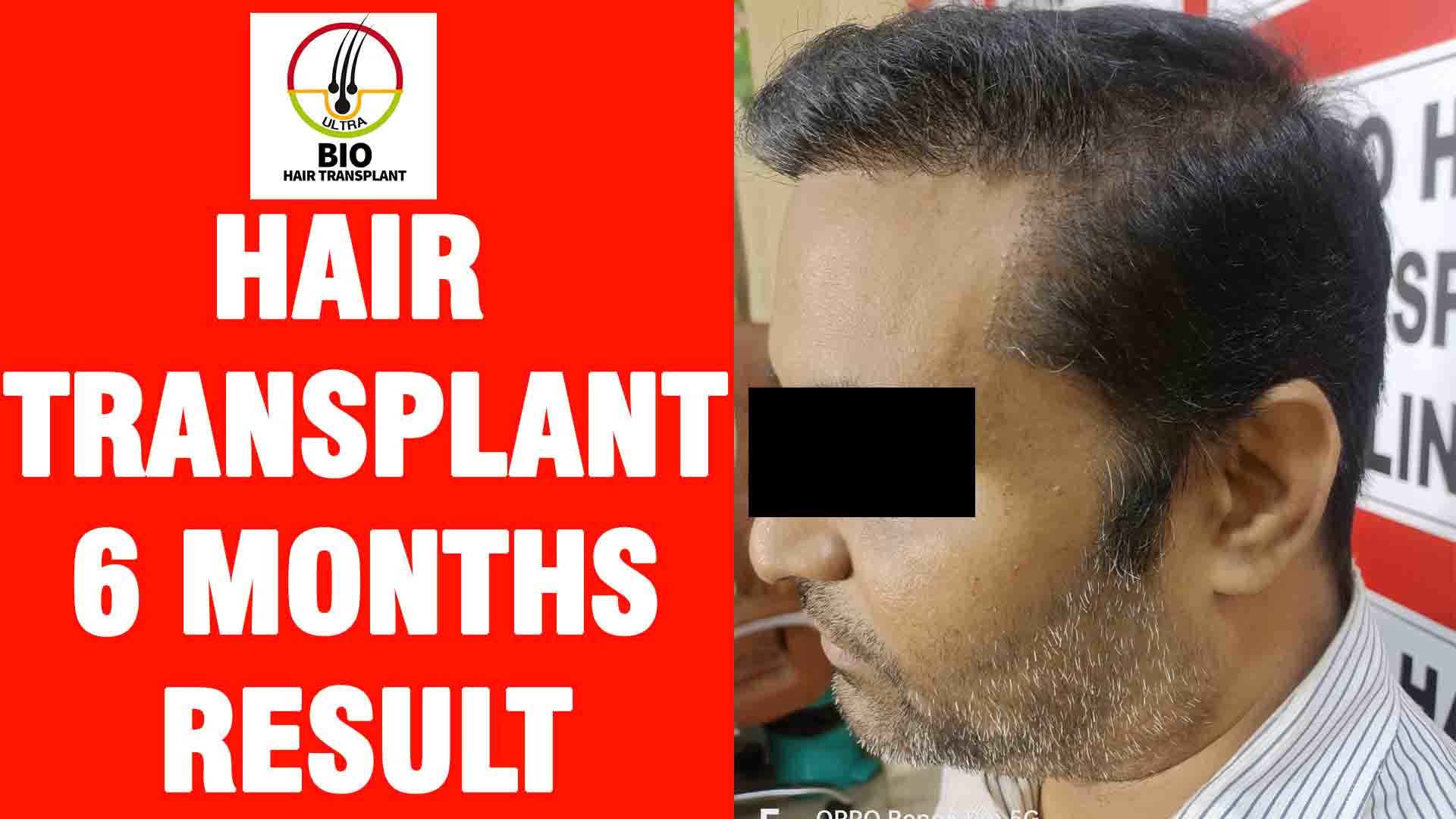 hair transplant 6 months result