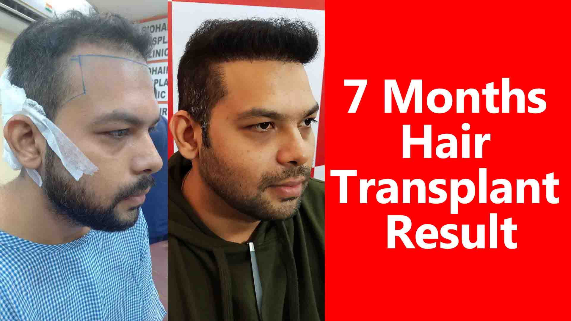 7 months hair transplant result