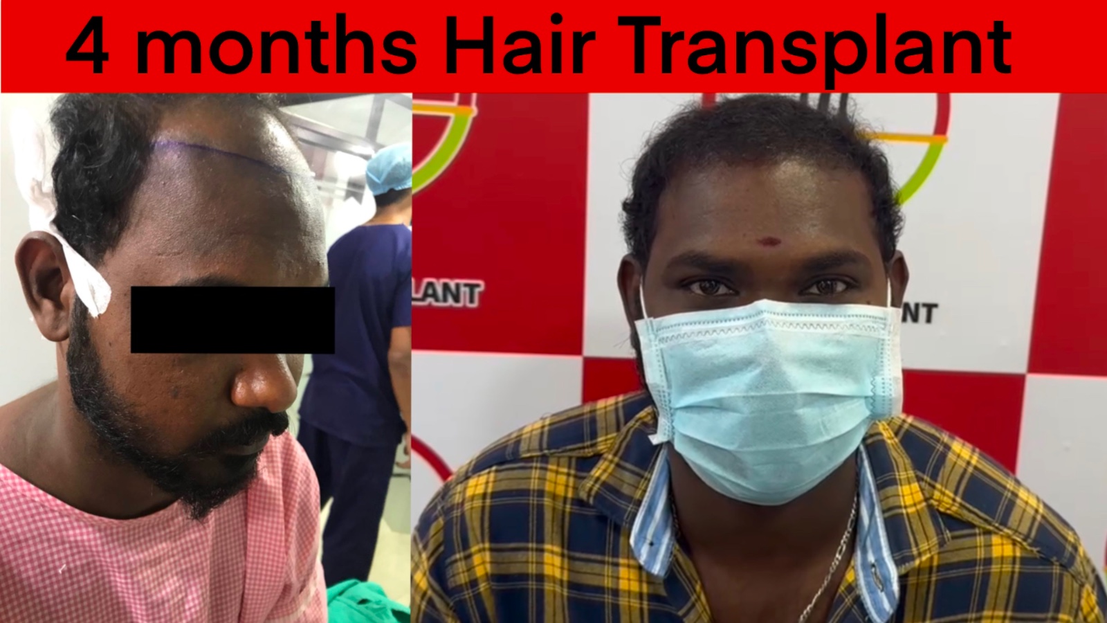 4 months hair transplant result